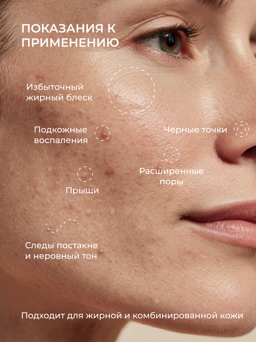 Сыворотка АКАВИЯ Anti-Аcne дневная с цинком - фото 3