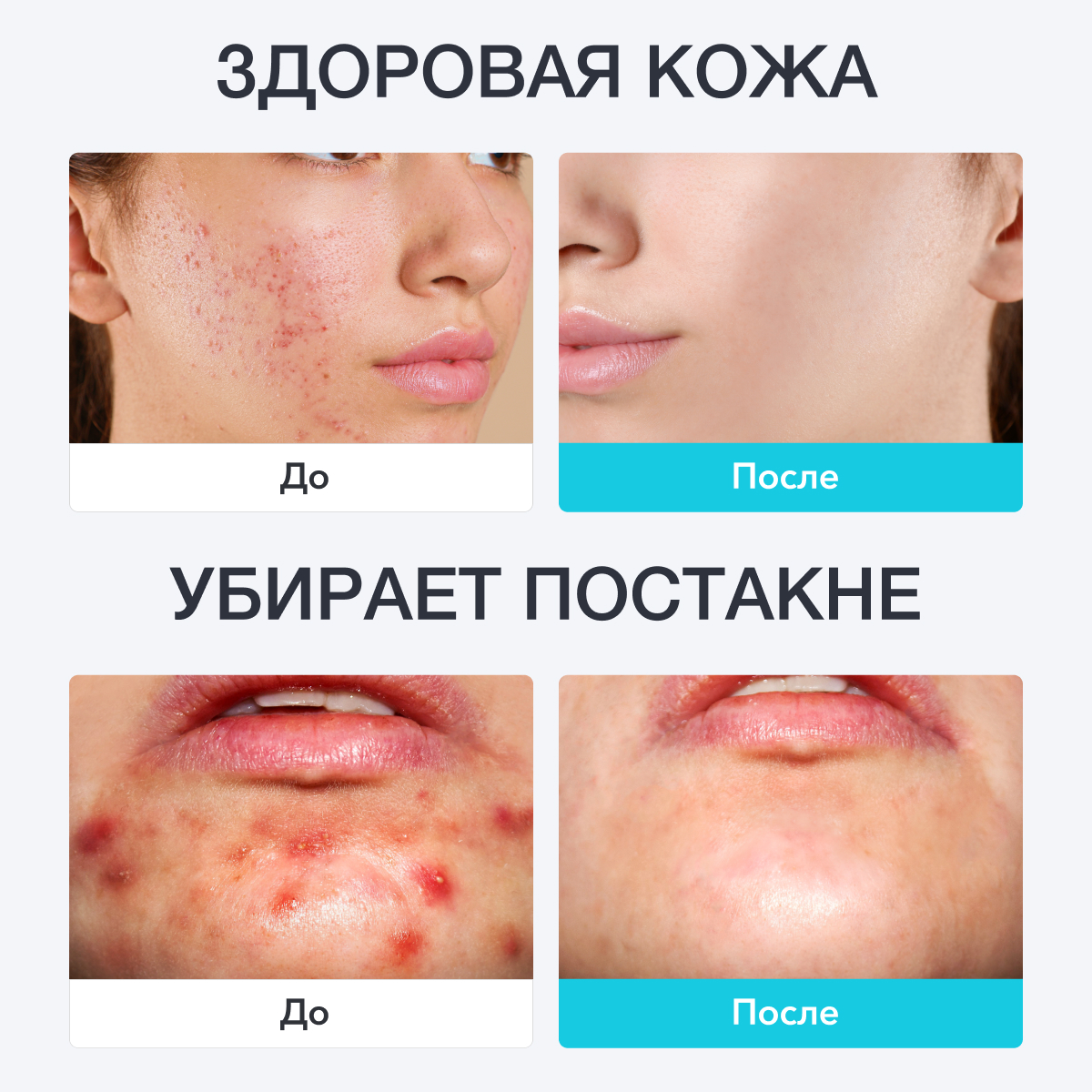 Набор средств Glatte от Акне - фото 13