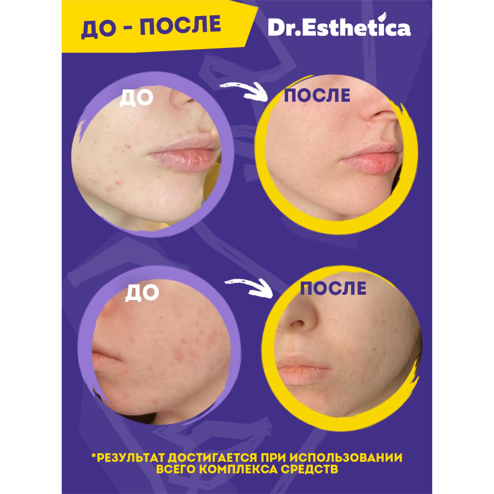 Крем Dr. Esthetica против прыщей 50 мл - фото 8