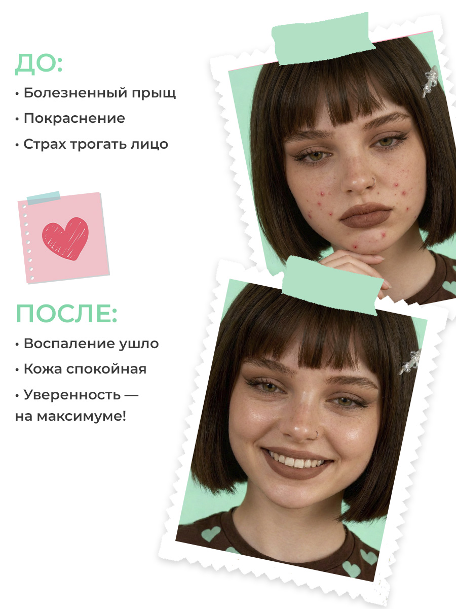 Гель EDEN Stop Acne 30 мл - фото 9