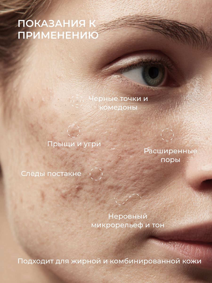 Сыворотка АКАВИЯ Anti-Аcne ночная с кислотами - фото 3