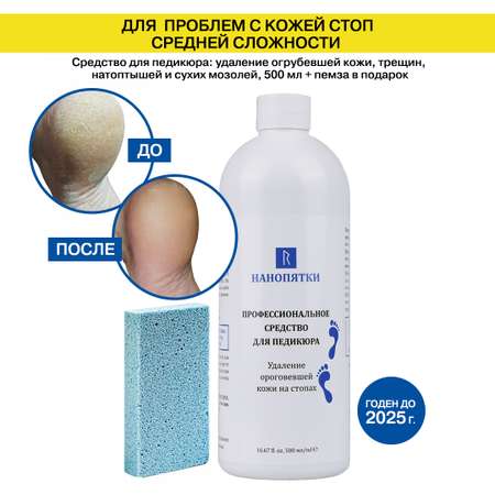 Крем НАНОПЯТКИ