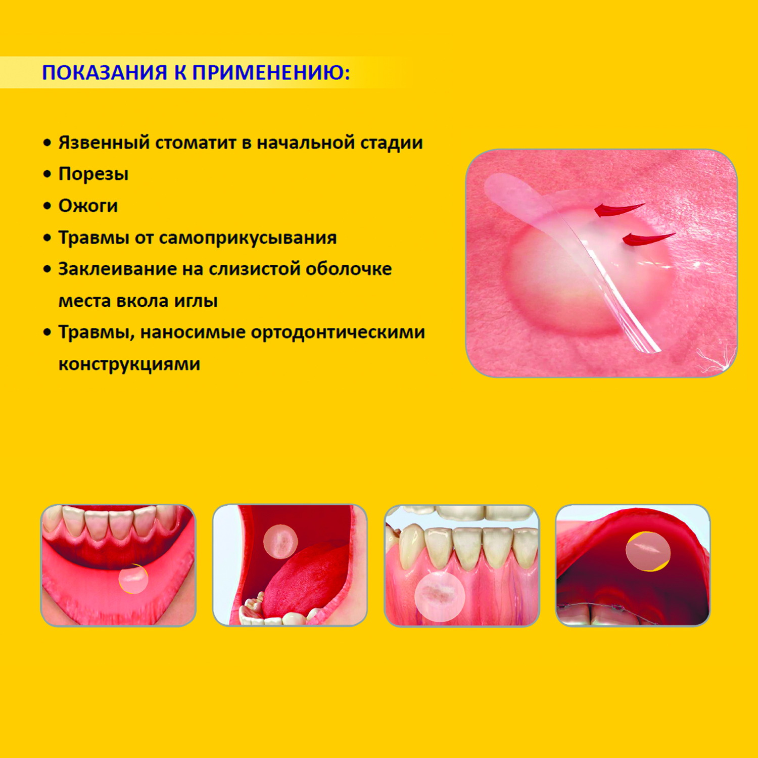 Набор заживляющих пластырей Curatick для полости рта (2+2шт) - фото 5