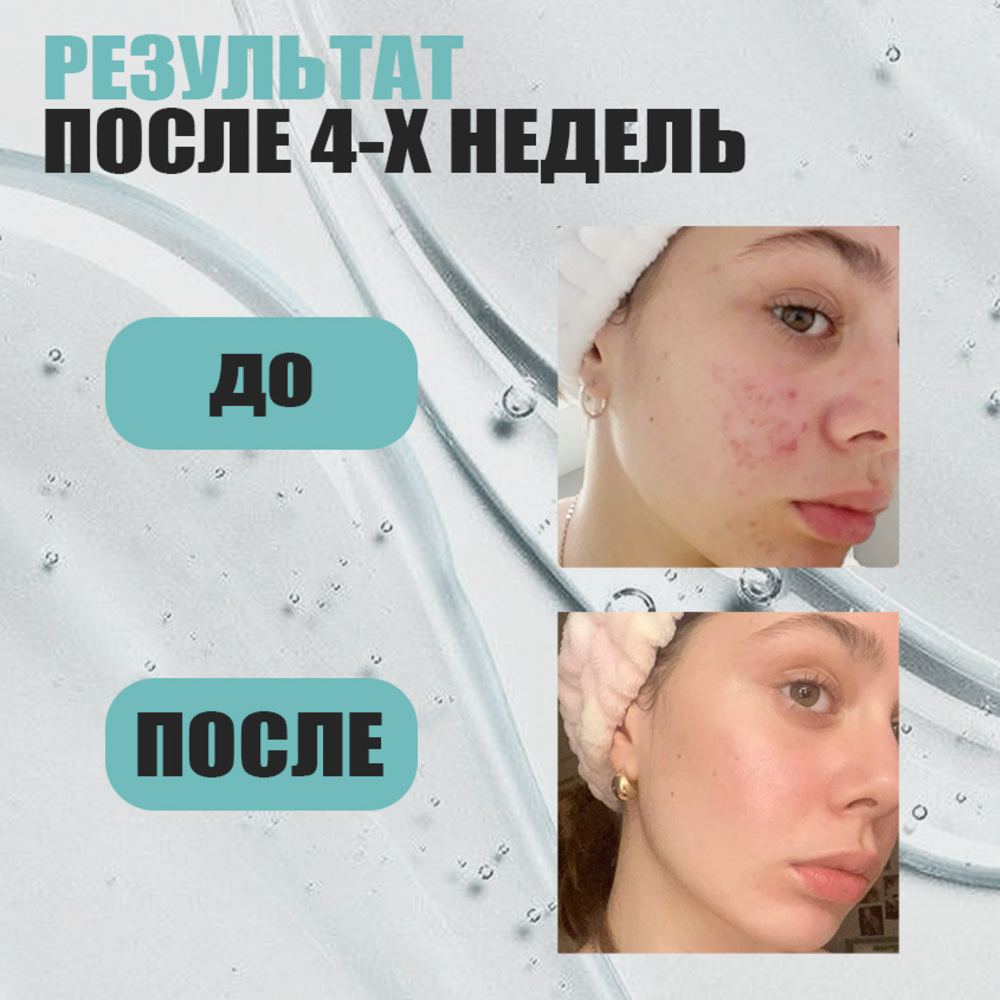 Гель EDEN Stop Acne 150 мл - фото 3
