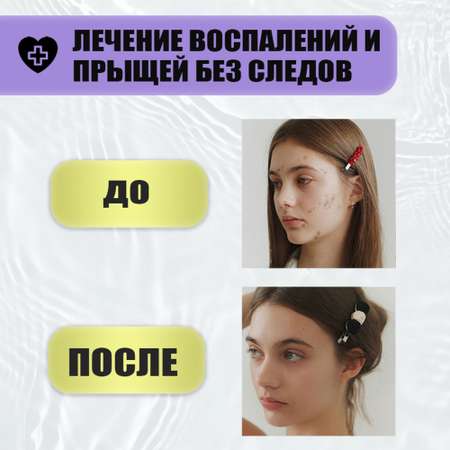 Гель EDEN Stop Acne 30 мл