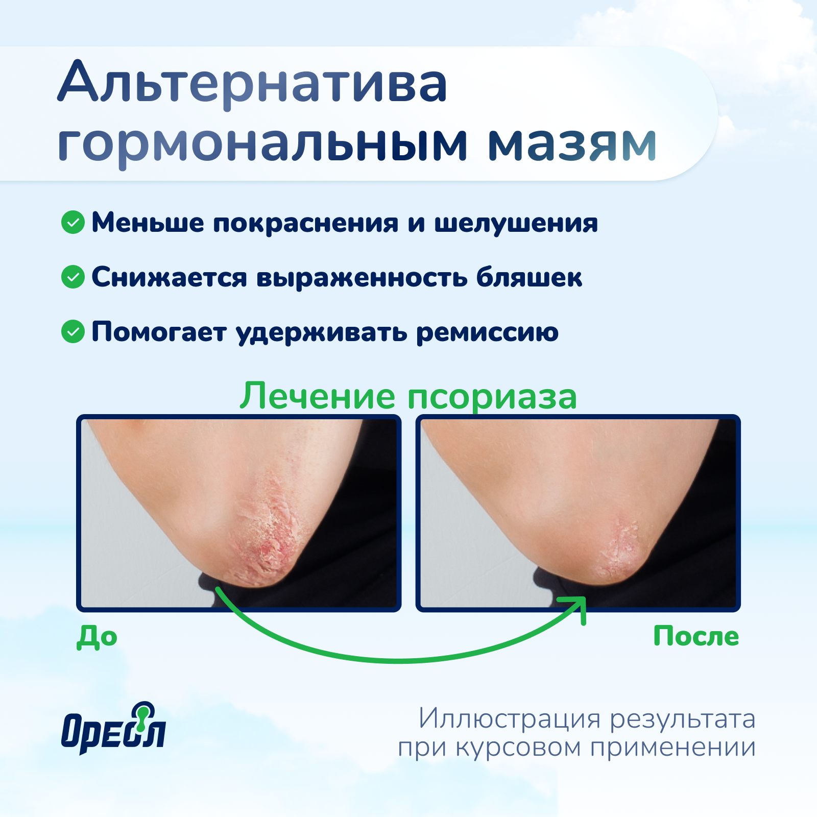 Ультрафиолетовая лампа Ореол Здоровья ОУФК-311 - фото 5