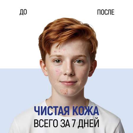 Пена Siberina От прыщей 150 мл