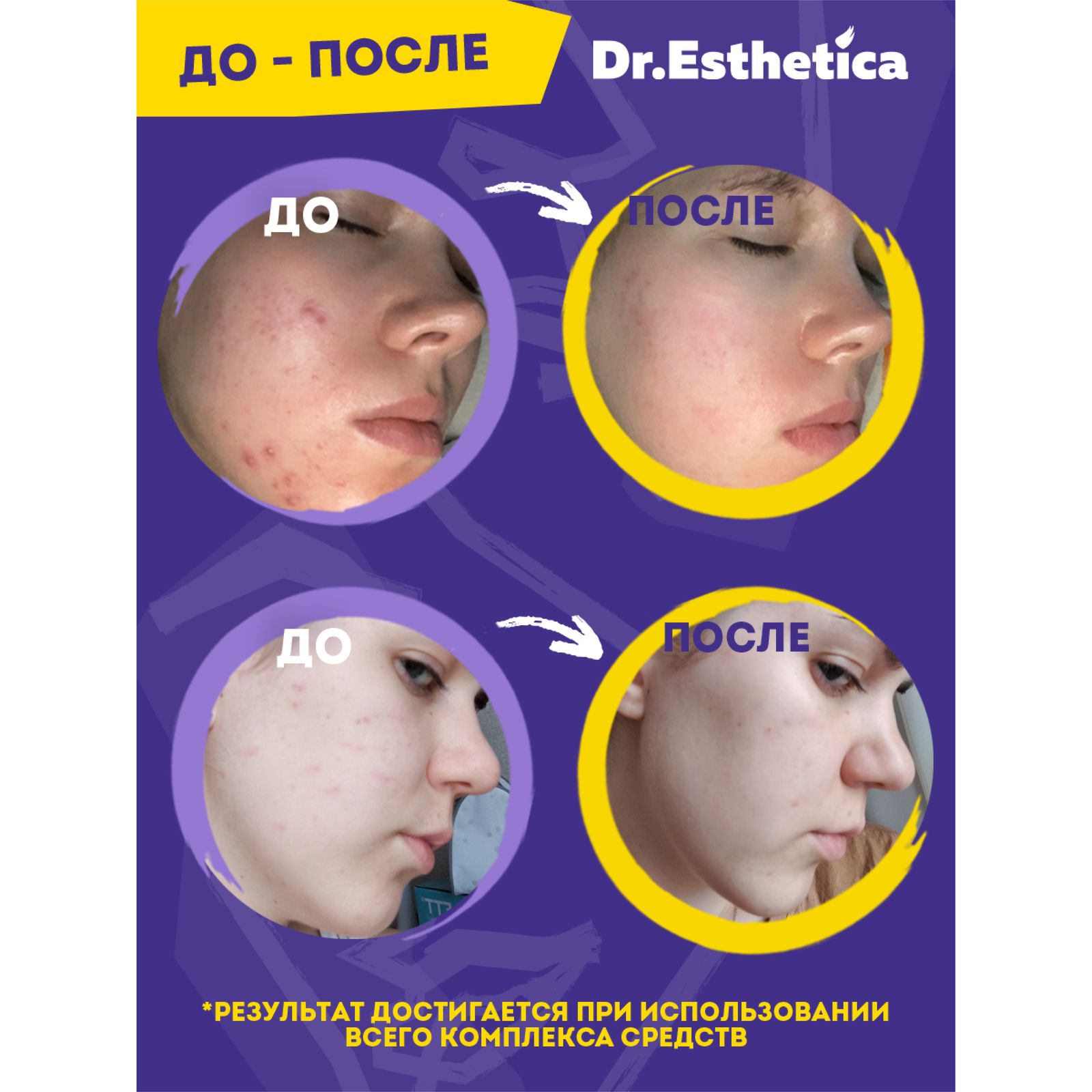 Крем Dr. Esthetica TEENS 20 мл - фото 7