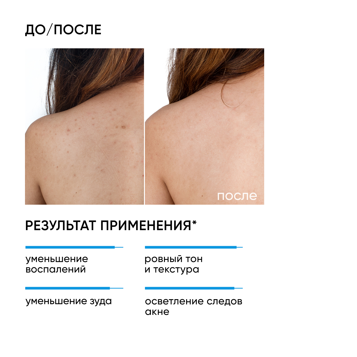 Сыворотка ICON SKIN acne free solution - фото 2