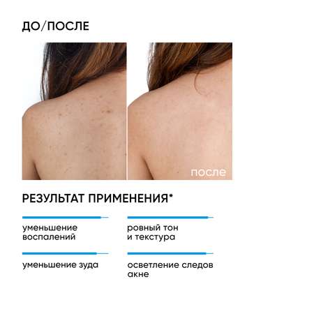 Сыворотка ICON SKIN acne free solution